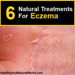 11 Useful Natural Treatments For Eczema