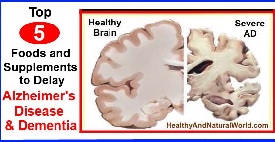 Top 5 Foods And Supplements To Delay Alzheimer's Disease And Dementia