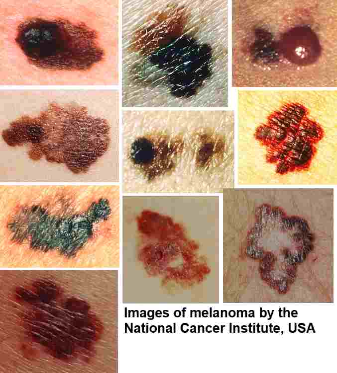 warning-signs-of-melanoma-the-most-deadly-form-of-skin-cancer