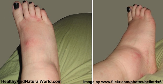 the-top-10-natural-remedies-for-swollen-ankles-legs-and-feet