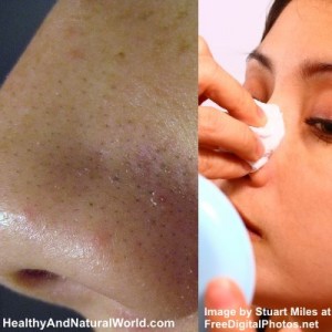 exposed acne treatment reviews