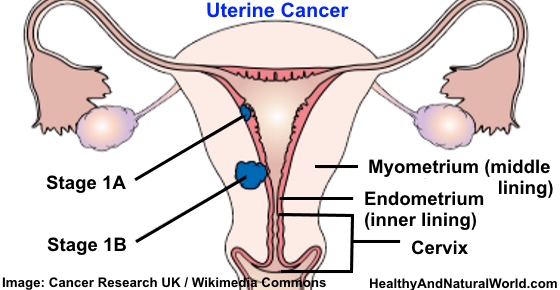 Uterine Endometrial Cancer – Symptoms Risk Factors And Prevention