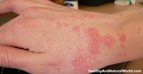 The Top 8 Home Remedies to Get Rid of Scabies Research Based