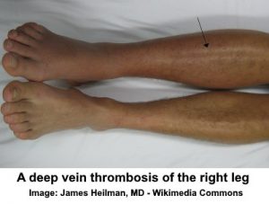 Blood Clot In Leg Signs Symptoms And Treatment Including Pictures