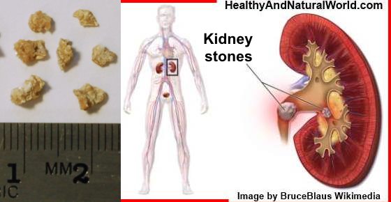 how does calcium affect kidney stones