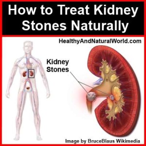 How to Treat Kidney Stones Naturally