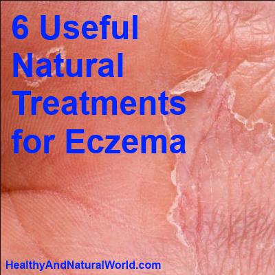 11 Useful Natural Treatments for Eczema