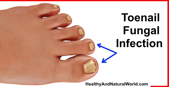 Natural Cures for Toenail Fungus