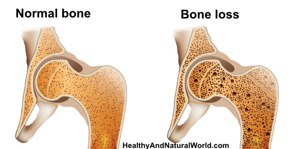 4 Steps to Prevent Osteoporosis