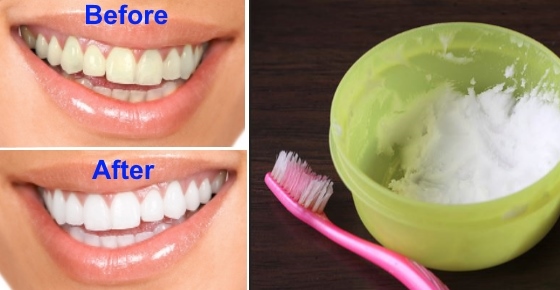 Best Teeth Whitening Home Remedies (Natural Teeth Whitening Methods)