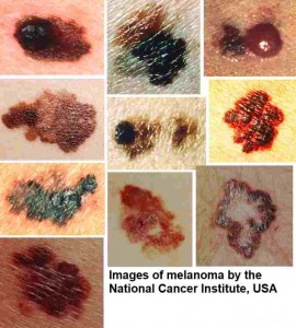 Warning Signs of Melanoma, The Most Deadly Form Of Skin Cancer