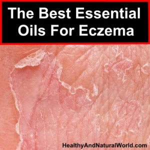 The Best Essential Oils For Eczema