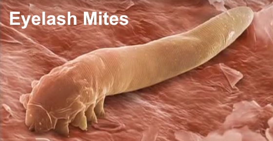 How To Detect And Eliminate Eyelash Mites Demodex Mites