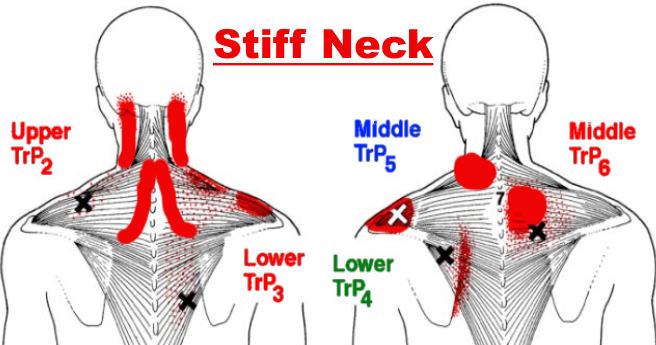 How To Treat Stiff Neck In One Minute or Less Detailed Instructions