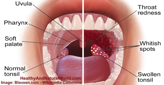 White Spots On Throat 6 Common Causes Images Included 