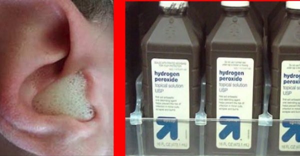 ear wax removal hydrogen peroxide