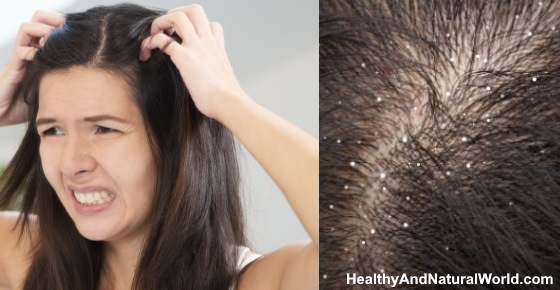 Dandruff vs Dry Scalp: Find the Differences and the Best Treatments