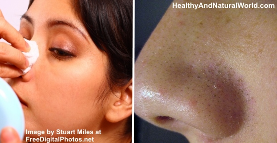 560px x 290px - How to get rid of blackheads and pimples overnight