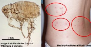 How to Get Rid Of Flea Bites Quickly and Naturally