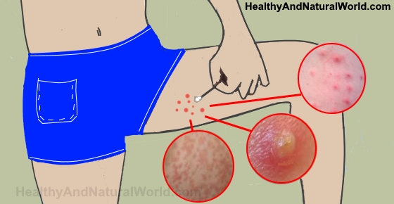 Dealing With Pimples on the Inner Thighs in Females