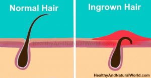 How To Get Rid Of Ingrown Hair On Head: Natural Ways That Really Work