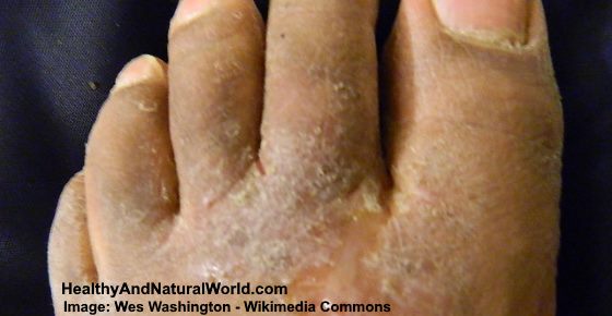 dry peeling skin on foot