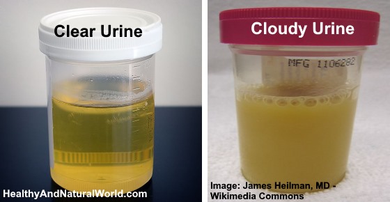 Cloudy Urine What Does It Mean And Is It A Reason For Concern 