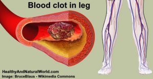clot clots calf healthyandnaturalworld dvt ignore thrombosis vein circulation veins shouldn