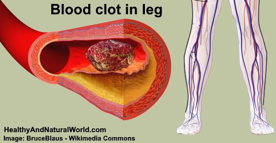 Blood Clot In Leg Signs Symptoms And Treatment Including Pictures 