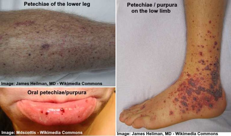 petechiae-causes-symptoms-and-treatments-including-images